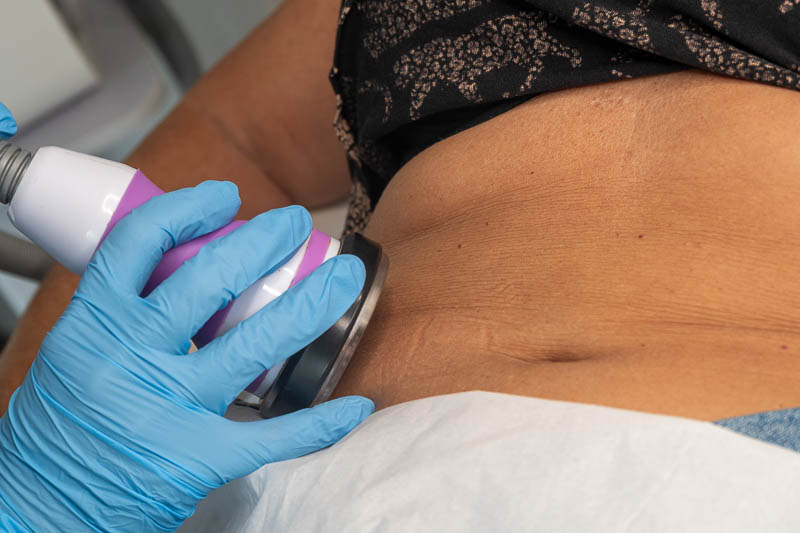 cavitation RF treatment