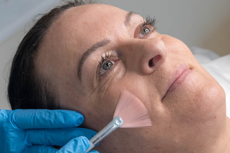 Chemical peel treatment
