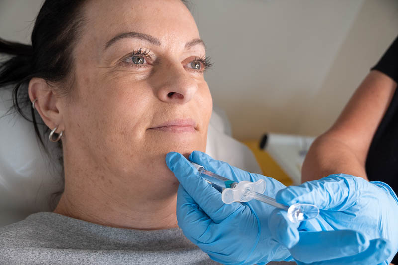 Dermal filler chin