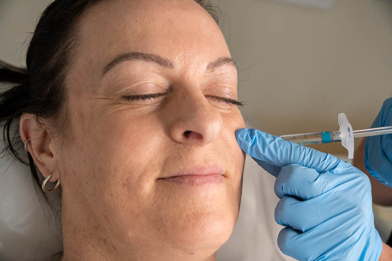 Dermal filler treatment
