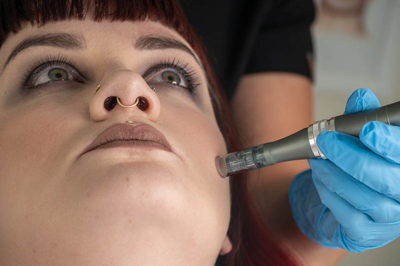 Microneedling treatment