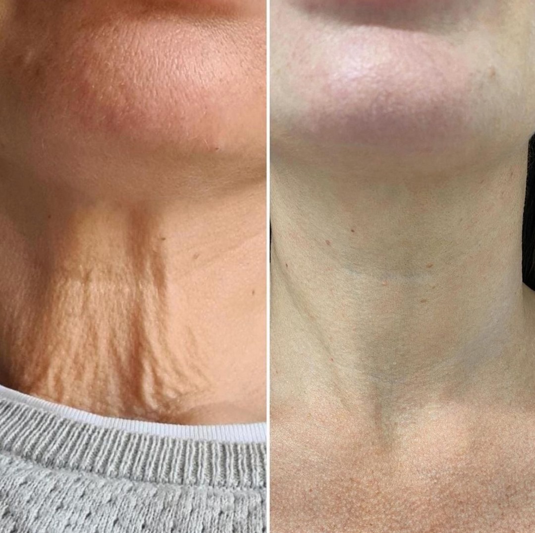 Hyaluronic Acid Treatment Before & After Blossom Aesthetics